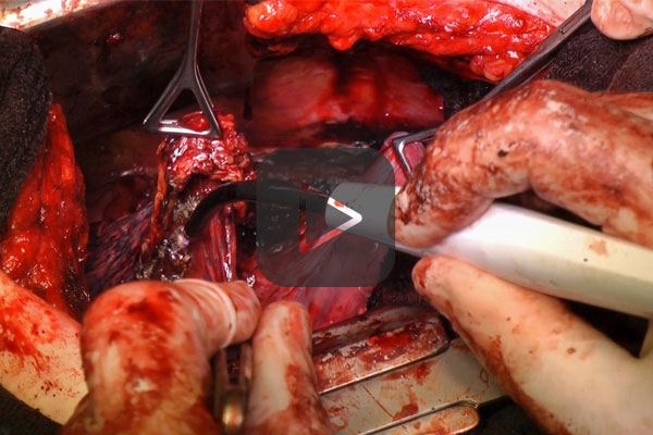 Lobectomy of the lung with APCapplicator
