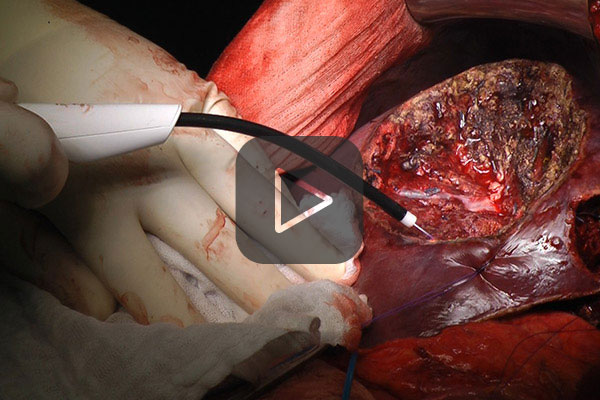Hemostasis after partial liver resection with APCapplicator