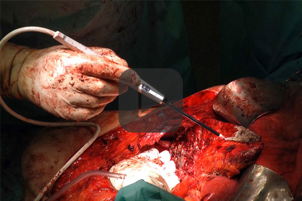 Partial liver resection with APCapplicator and Applicator monopolar