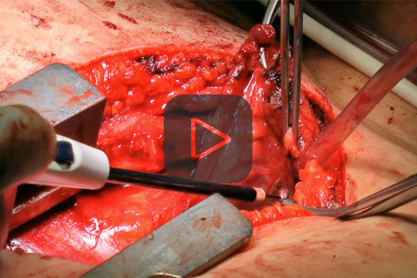 Thymus resection with APCapplicator